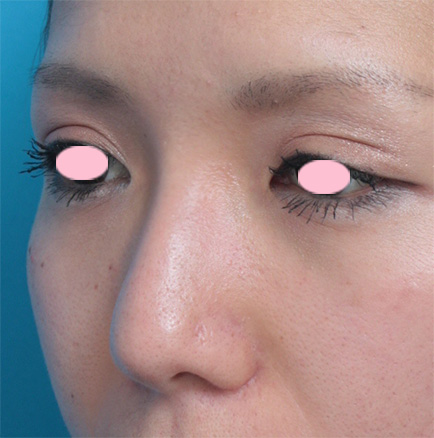 鼻翼縮小（小鼻縮小）,鼻翼（小鼻）縮小+鼻のヒアルロン酸注射症例写真,After（1ヶ月後）,ba_biyoku19_b.jpg