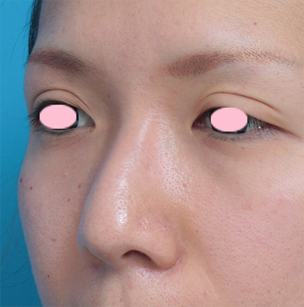 鼻翼縮小（小鼻縮小）,鼻翼（小鼻）縮小+鼻のヒアルロン酸注射症例写真,Before,ba_biyoku19_b.jpg