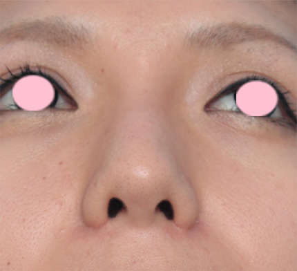 鼻翼縮小（小鼻縮小）,鼻翼（小鼻）縮小+鼻のヒアルロン酸注射症例写真,After（1ヶ月後）,ba_biyoku20_b.jpg