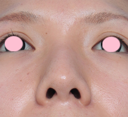 鼻翼縮小（小鼻縮小）,鼻翼（小鼻）縮小+鼻のヒアルロン酸注射症例写真,Before,ba_biyoku20_b.jpg