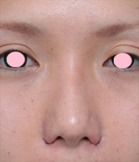 鼻翼縮小（小鼻縮小）,鼻翼（小鼻）縮小+鼻のヒアルロン酸注射症例写真,手術直後,mainpic_biyoku03b.jpg