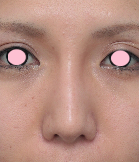 鼻翼縮小（小鼻縮小）,鼻翼（小鼻）縮小+鼻のヒアルロン酸注射症例写真,1ヶ月後,mainpic_biyoku03d.jpg