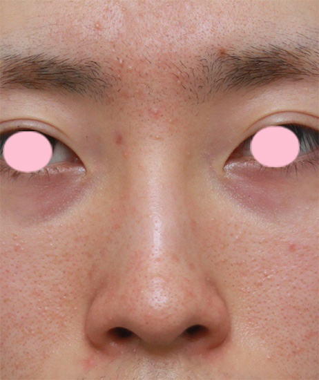 鼻翼縮小（小鼻縮小）,男性の鼻翼（小鼻）縮小症例写真,手術前,mainpic_biyoku04a.jpg