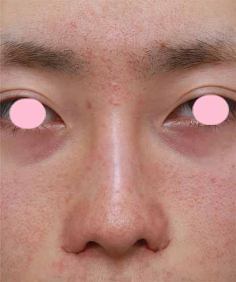 鼻翼縮小（小鼻縮小）,男性の鼻翼（小鼻）縮小症例写真,手術直後,mainpic_biyoku04b.jpg