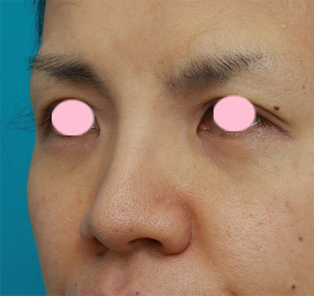 鼻翼縮小（小鼻縮小）,鼻翼（小鼻）縮小で、鼻の穴の内側から外側にかけて大きく切開した症例写真,Before,ba_biyoku27_b.jpg