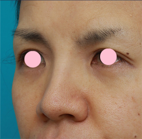 鼻翼縮小（小鼻縮小）,鼻翼（小鼻）縮小で、鼻の穴の内側から外側にかけて大きく切開した症例写真,手術前,mainpic_biyoku05e.jpg