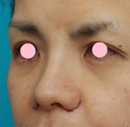 鼻翼縮小（小鼻縮小）,鼻翼（小鼻）縮小で、鼻の穴の内側から外側にかけて大きく切開した症例写真,手術直後,mainpic_biyoku05f.jpg