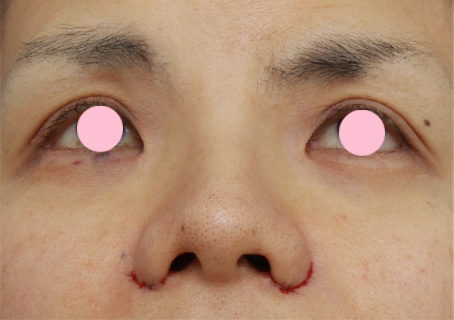 症例写真,鼻翼（小鼻）縮小で、鼻の穴の内側から外側にかけて大きく切開した症例写真,手術直後,mainpic_biyoku05j.jpg