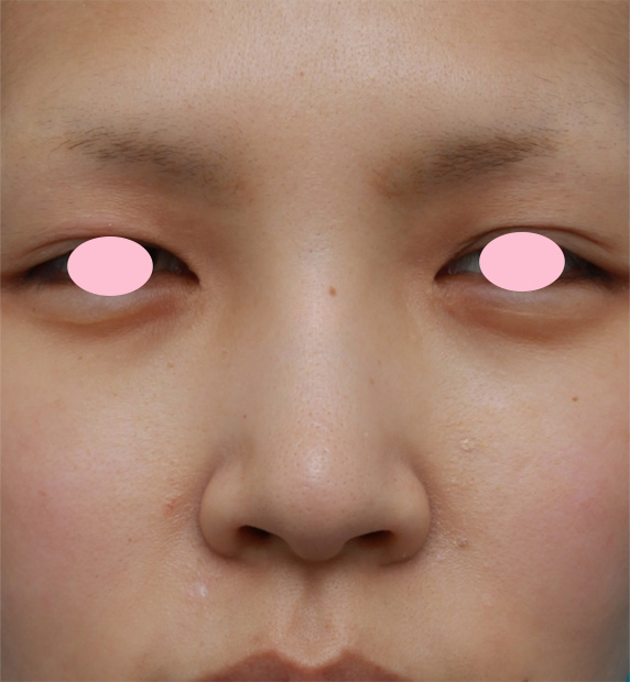 鼻翼縮小（小鼻縮小）,鼻翼（小鼻）縮小手術で、自然な範囲内で最大限小鼻を小さくした症例写真,Before,ba_biyoku29_b.jpg