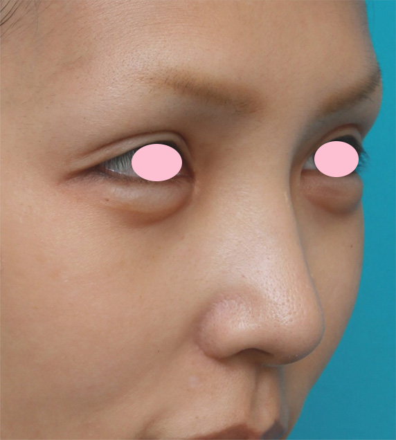 鼻翼縮小（小鼻縮小）,鼻翼（小鼻）縮小手術で、自然な範囲内で最大限小鼻を小さくした症例写真,After（3ヶ月後）,ba_biyoku30_b.jpg