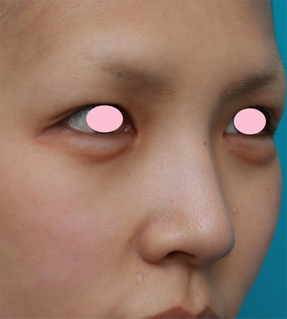 鼻翼縮小（小鼻縮小）,鼻翼（小鼻）縮小手術で、自然な範囲内で最大限小鼻を小さくした症例写真,Before,ba_biyoku30_b.jpg