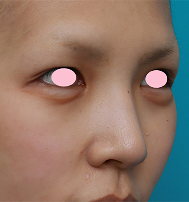 鼻翼縮小（小鼻縮小）,鼻翼（小鼻）縮小手術で、自然な範囲内で最大限小鼻を小さくした症例写真,手術前,mainpic_biyoku06e.jpg