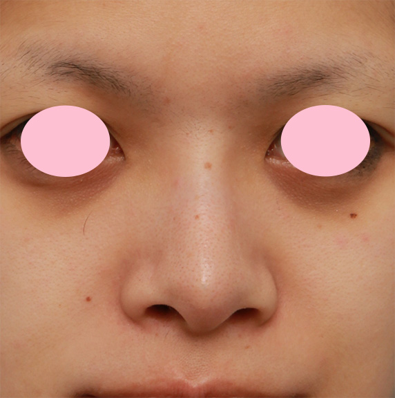 小鼻（鼻翼）縮小手術で、横に大きく広がった鼻の穴を小さくした症例写真,Before,ba_biyoku36_b.jpg