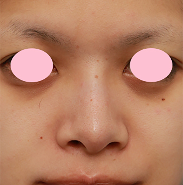 鼻翼縮小（小鼻縮小）,小鼻（鼻翼）縮小手術で、横に大きく広がった鼻の穴を小さくした症例写真,手術前,mainpic_biyoku09a.jpg