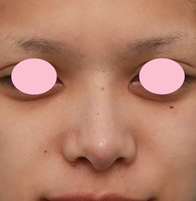 鼻翼縮小（小鼻縮小）,小鼻（鼻翼）縮小手術で、横に大きく広がった鼻の穴を小さくした症例写真,1ヶ月後,mainpic_biyoku09d.jpg