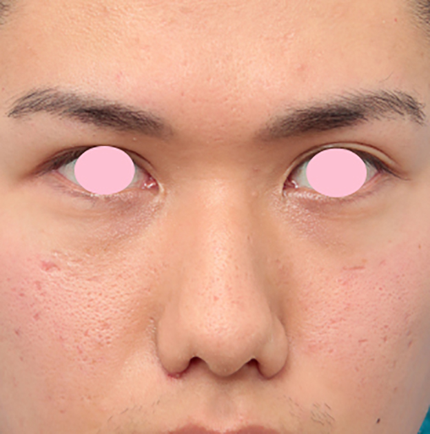 症例写真,小鼻縮小（鼻翼縮小）手術で、正面から見て目立っていた鼻の穴を目立たなくした男性の症例写真の術前術後画像,1週間後,mainpic_biyoku10c.jpg