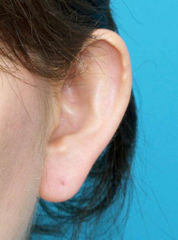 立ち耳,立ち耳の症例 いつも耳を隠すような髪型をしていた30代女性,Before,ba_tachimimi02_b.jpg