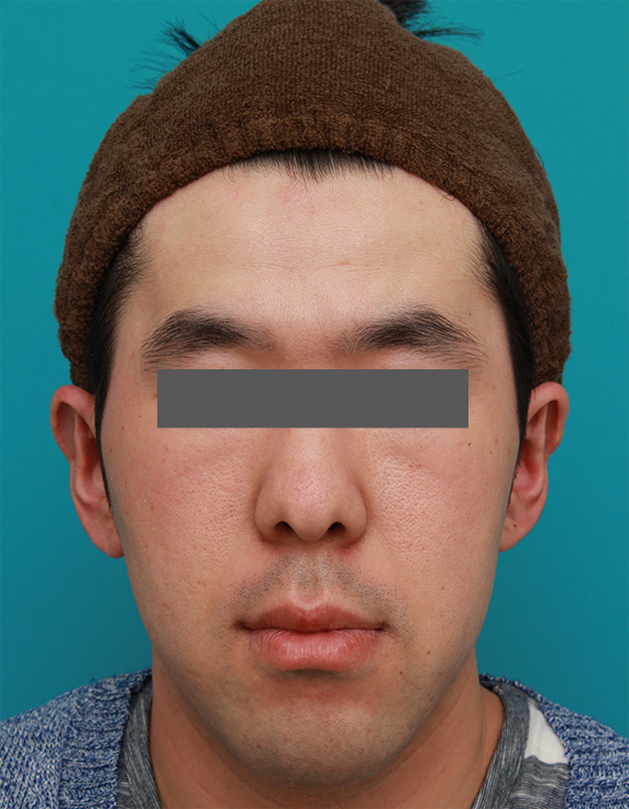 立ち耳,立ち耳を修正手術で治した症例写真,After（1ヶ月後）,ba_tachimimi03_b01.jpg