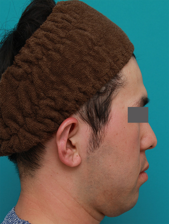 立ち耳,立ち耳を修正手術で治した症例写真,After（1ヶ月後）,ba_tachimimi03_b03.jpg