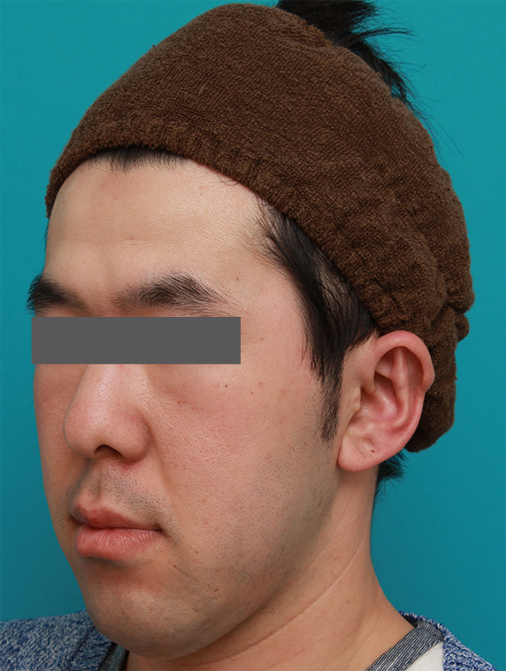 立ち耳,立ち耳を修正手術で治した症例写真,After（1ヶ月後）,ba_tachimimi03_b04.jpg