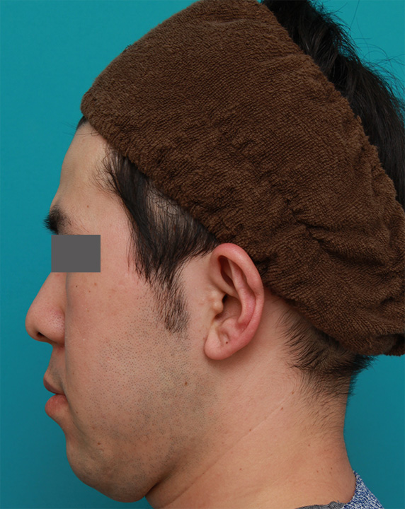 立ち耳,立ち耳を修正手術で治した症例写真,After（1ヶ月後）,ba_tachimimi03_b05.jpg