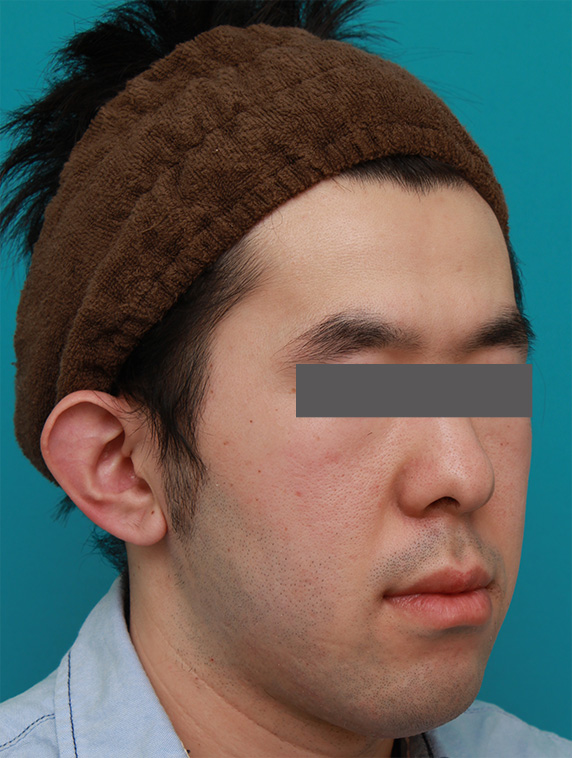 症例写真,立ち耳を修正手術で治した症例写真,Before,ba_tachimimi03_b02.jpg