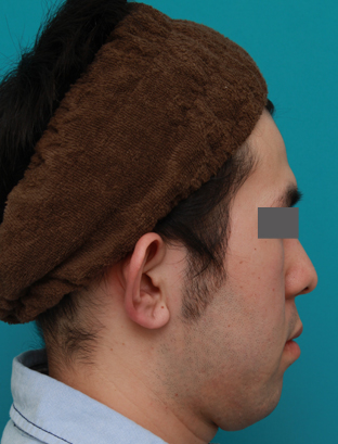 立ち耳,立ち耳を修正手術で治した症例写真,手術前,mainpic_tachimimi03a.jpg