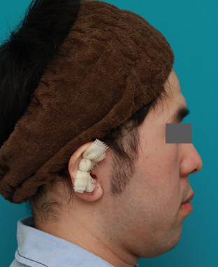 立ち耳,立ち耳を修正手術で治した症例写真,手術直後,mainpic_tachimimi03b.jpg