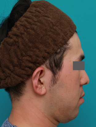 症例写真,立ち耳を修正手術で治した症例写真,1ヶ月後,mainpic_tachimimi03d.jpg