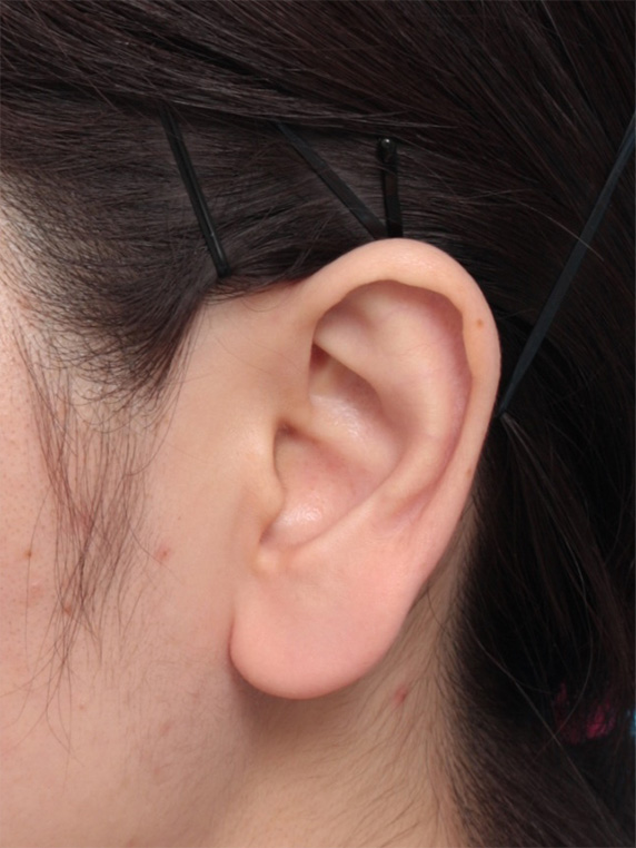 その他の耳の手術,福耳のように大きく垂れ下がっている耳たぶを小さく修正手術した症例写真,Before,ba_mimiother10_b.jpg