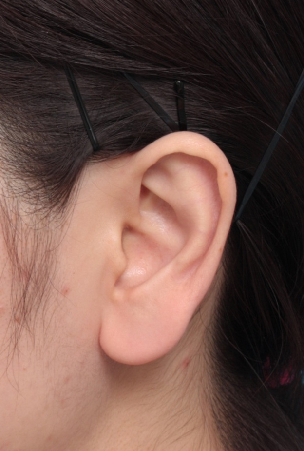 その他の耳の手術,福耳のように大きく垂れ下がっている耳たぶを小さく修正手術した症例写真,手術前,mainpic_mimiother06a.jpg