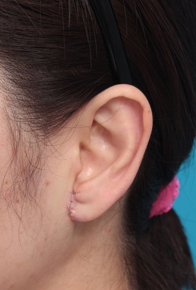 その他の耳の手術,福耳のように大きく垂れ下がっている耳たぶを小さく修正手術した症例写真,手術直後,mainpic_mimiother06b.jpg