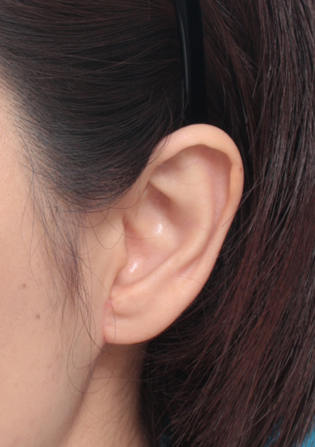 その他の耳の手術,福耳のように大きく垂れ下がっている耳たぶを小さく修正手術した症例写真,1週間後,mainpic_mimiother06c.jpg