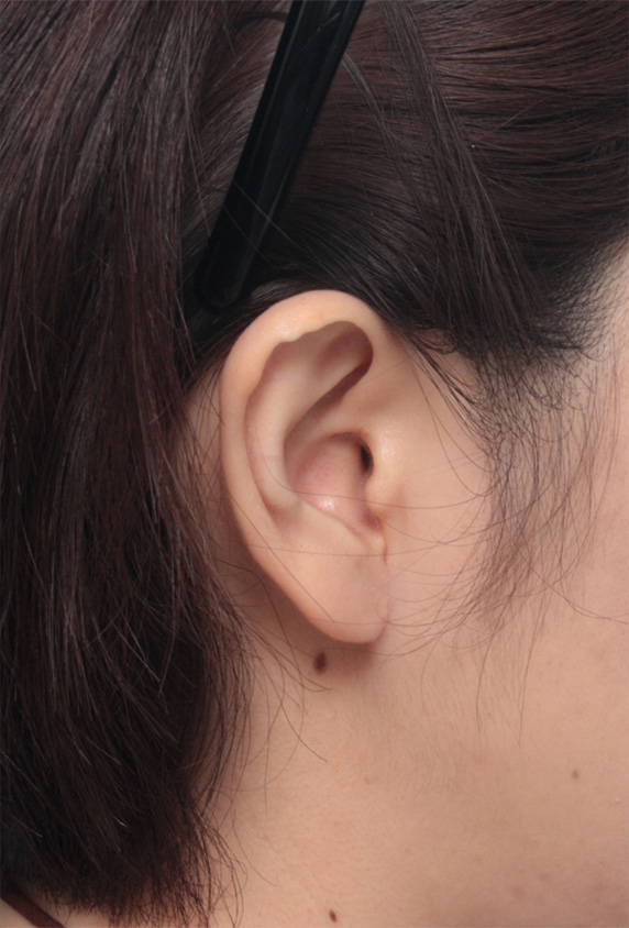 大きい耳たぶを傷痕を目立たせず小さく修正手術した症例写真 その他の耳の手術 ： 美容整形の高須クリニック（東京赤坂・横浜・名古屋・大阪）