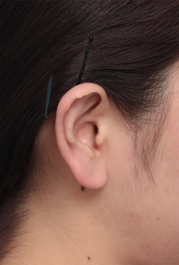 その他の耳の手術,大きい耳たぶを傷痕を目立たせず小さく修正手術した症例写真,Before,ba_mimiother09_b.jpg