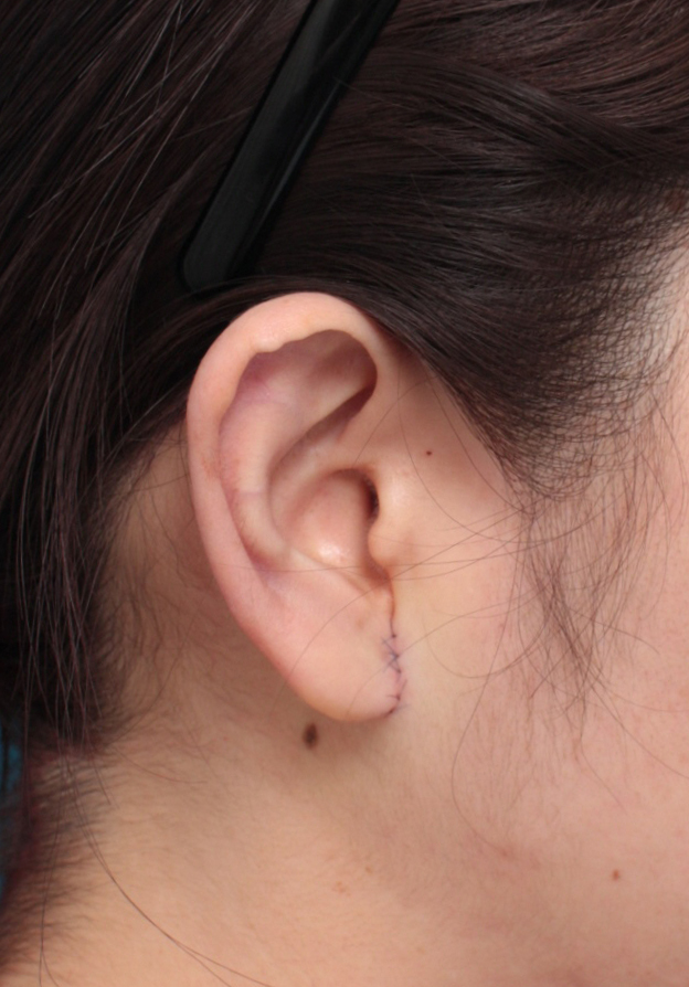 その他の耳の手術,大きい耳たぶを傷痕を目立たせず小さく修正手術した症例写真,手術直後,mainpic_mimiother05b.jpg