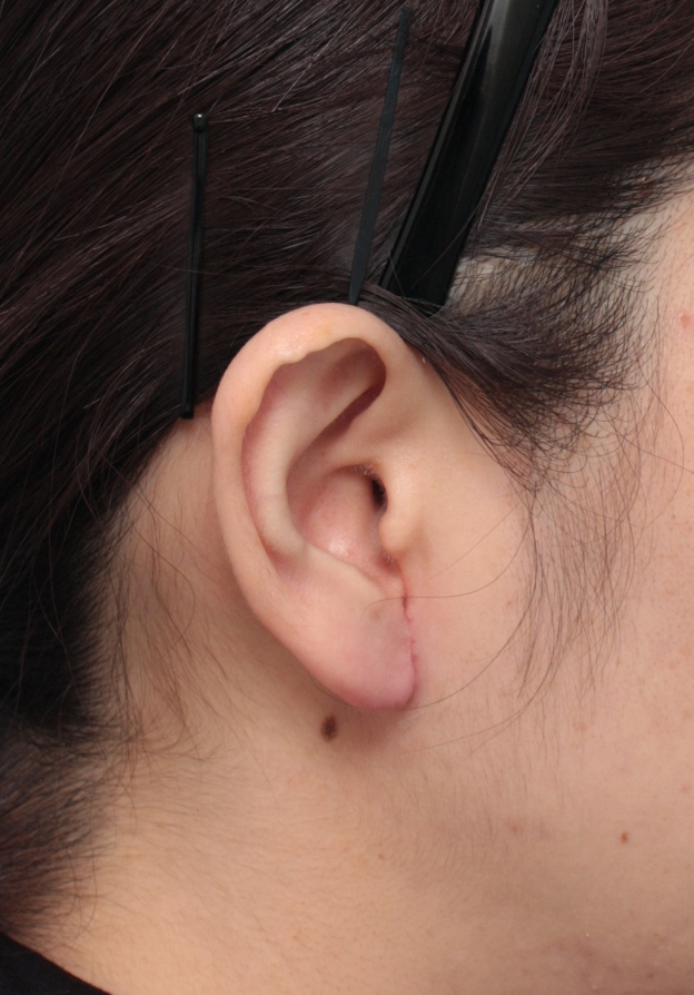 その他の耳の手術,大きい耳たぶを傷痕を目立たせず小さく修正手術した症例写真,1週間後,mainpic_mimiother05c.jpg