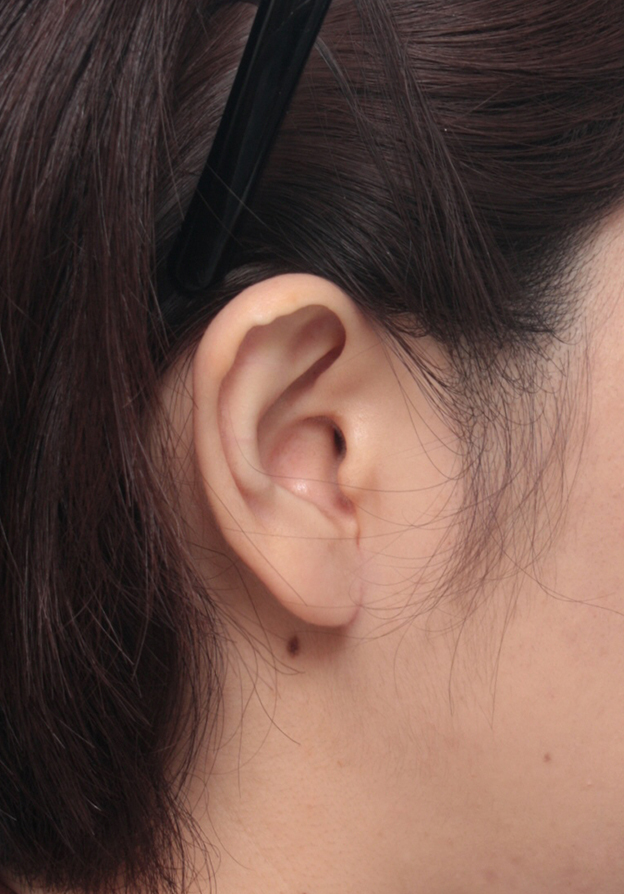 その他の耳の手術,大きい耳たぶを傷痕を目立たせず小さく修正手術した症例写真,4ヶ月後,mainpic_mimiother05e.jpg