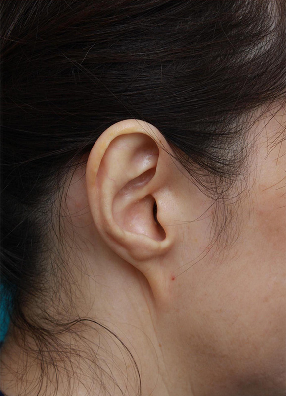 耳たぶのくびれを手術で作った症例写真,Before,ba_mimiother08_b.jpg