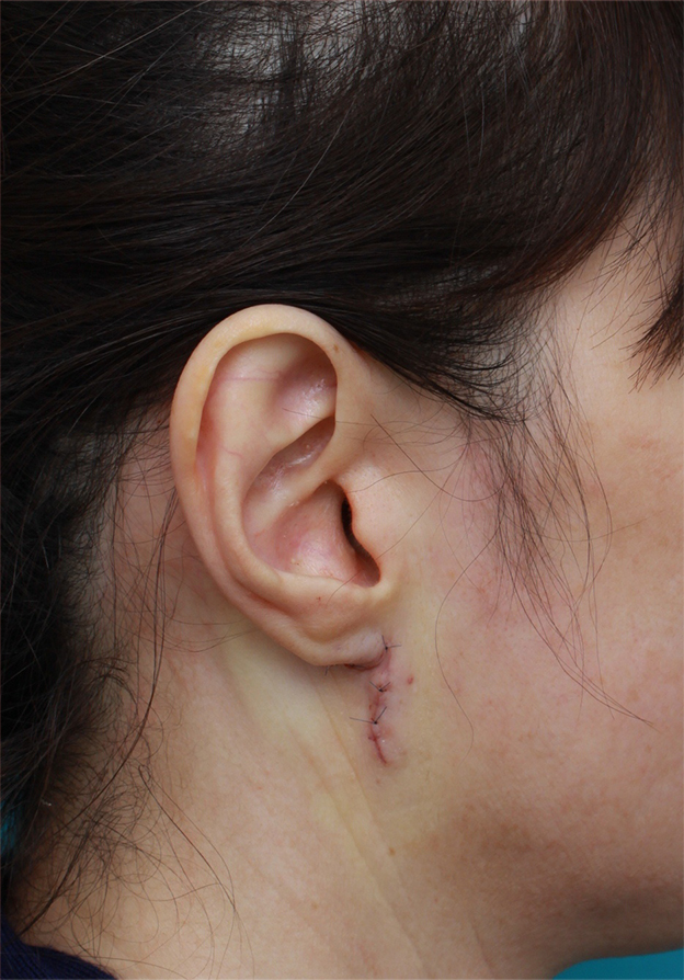その他の耳の手術,耳たぶのくびれを手術で作った症例写真,手術直後,mainpic_mimiother04b.jpg