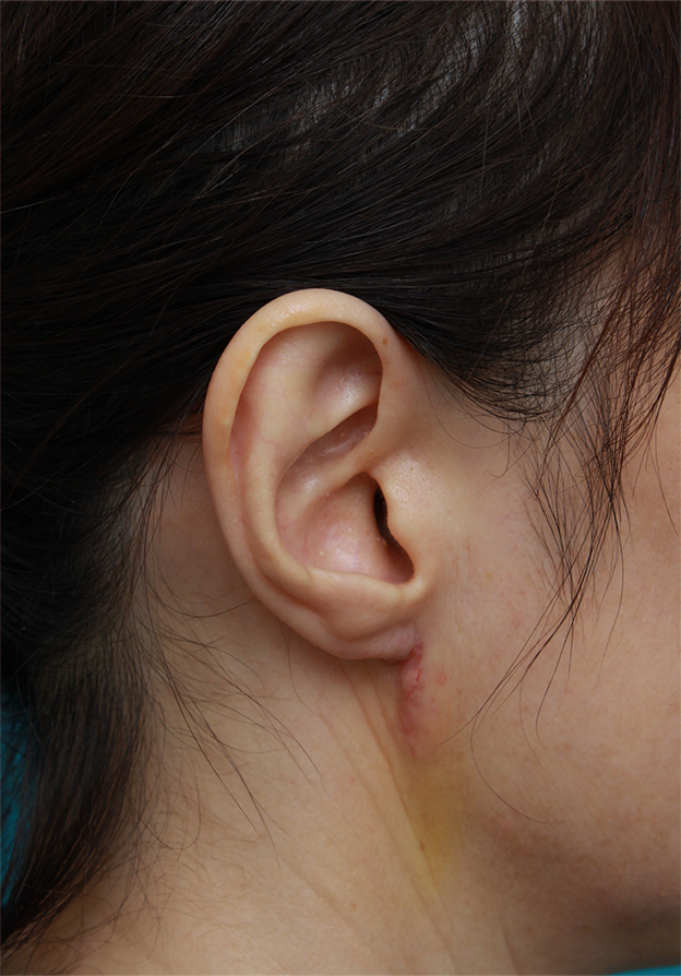 その他の耳の手術,耳たぶのくびれを手術で作った症例写真,1週間後,mainpic_mimiother04c.jpg