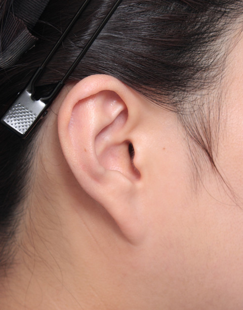 その他の耳の手術,垂れ下がった耳たぶを修正手術した症例写真,手術前,mainpic_mimiother03a.jpg