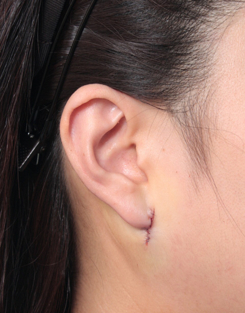 症例写真,垂れ下がった耳たぶを修正手術した症例写真,手術直後,mainpic_mimiother03b.jpg