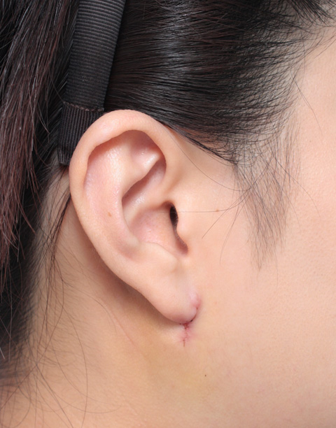 その他の耳の手術,垂れ下がった耳たぶを修正手術した症例写真,1週間後,mainpic_mimiother03c.jpg
