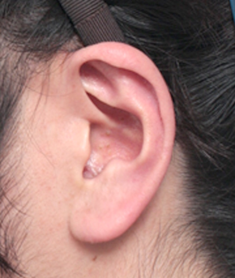 症例写真,耳たぶの縮小手術の症例写真,手術前,mainpic_mimiother02a.jpg