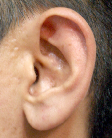 症例写真,大きくたれている耳たぶを修正した症例写真,Before,ba_mimiother03_b.jpg