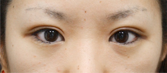 症例写真,二重まぶた・全切開法の症例 術後1ヶ月経過した20代女性,After（メイクなし）,ba_sekkai11_b.jpg