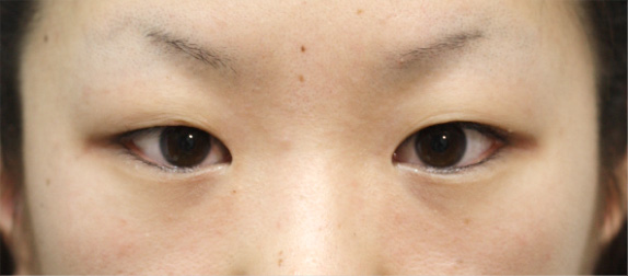 症例写真,二重まぶた・全切開法の症例 術後1ヶ月経過した20代女性,Before,ba_sekkai11_b.jpg