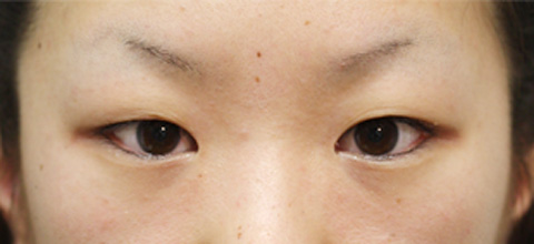 症例写真,二重まぶた・全切開法の症例 術後1ヶ月経過した20代女性,手術前,mainpic_sekkai05a.jpg