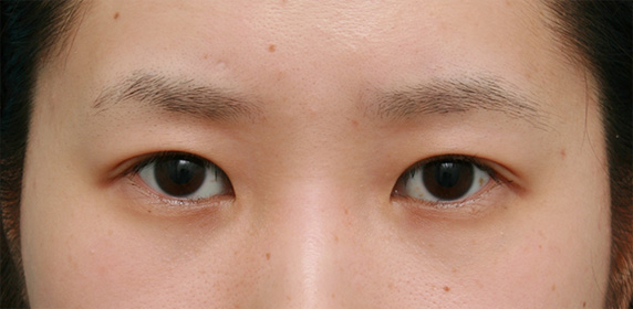 二重まぶた・全切開法,二重まぶた・全切開法の症例 まぶたに脂肪が多く腫れぼったい目だった女性,After（メイクなし）,ba_sekkai07_a01.jpg